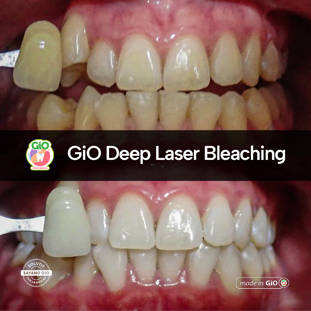 treatment-gio-deep-laser-bleaching