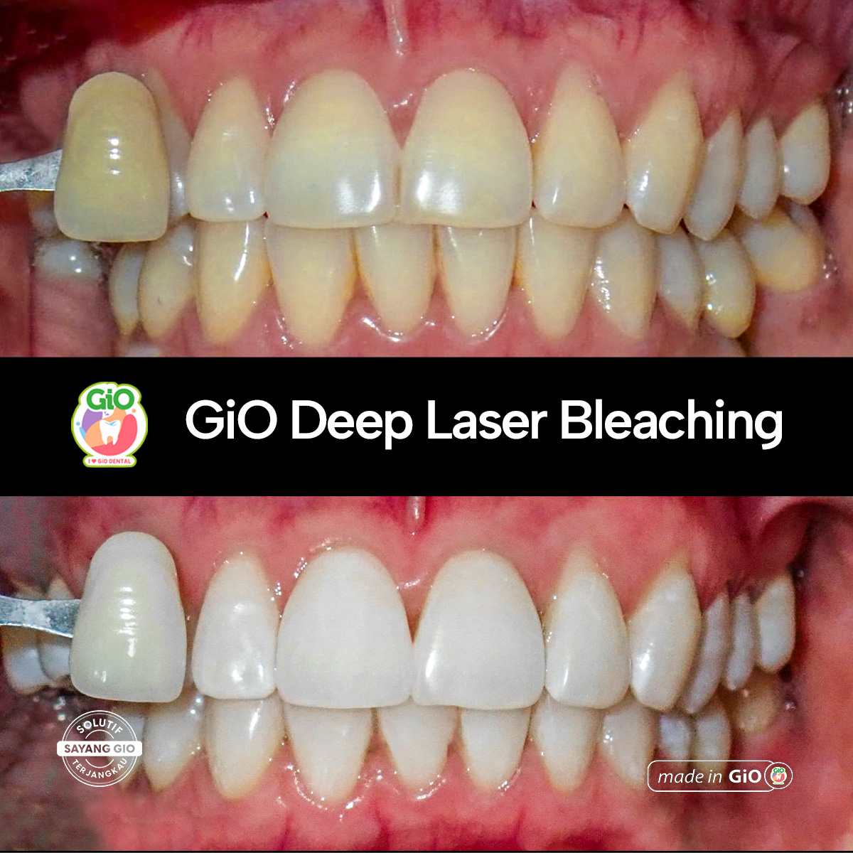 treatment-gio-deep-laser-bleaching