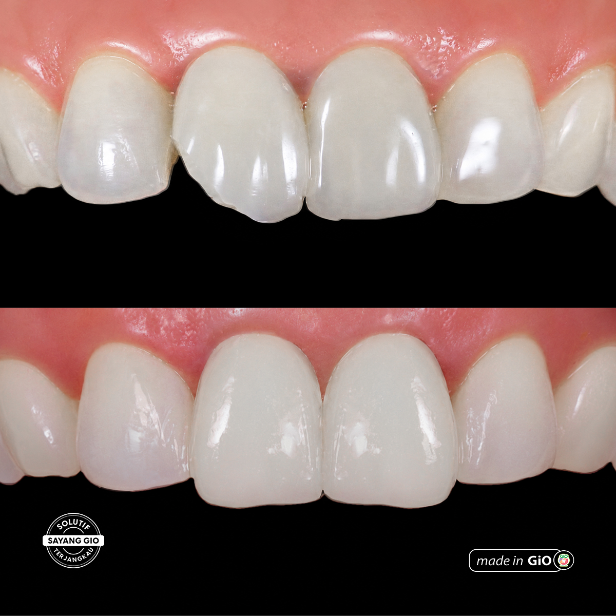 treatment-gio-healthy-veneer
