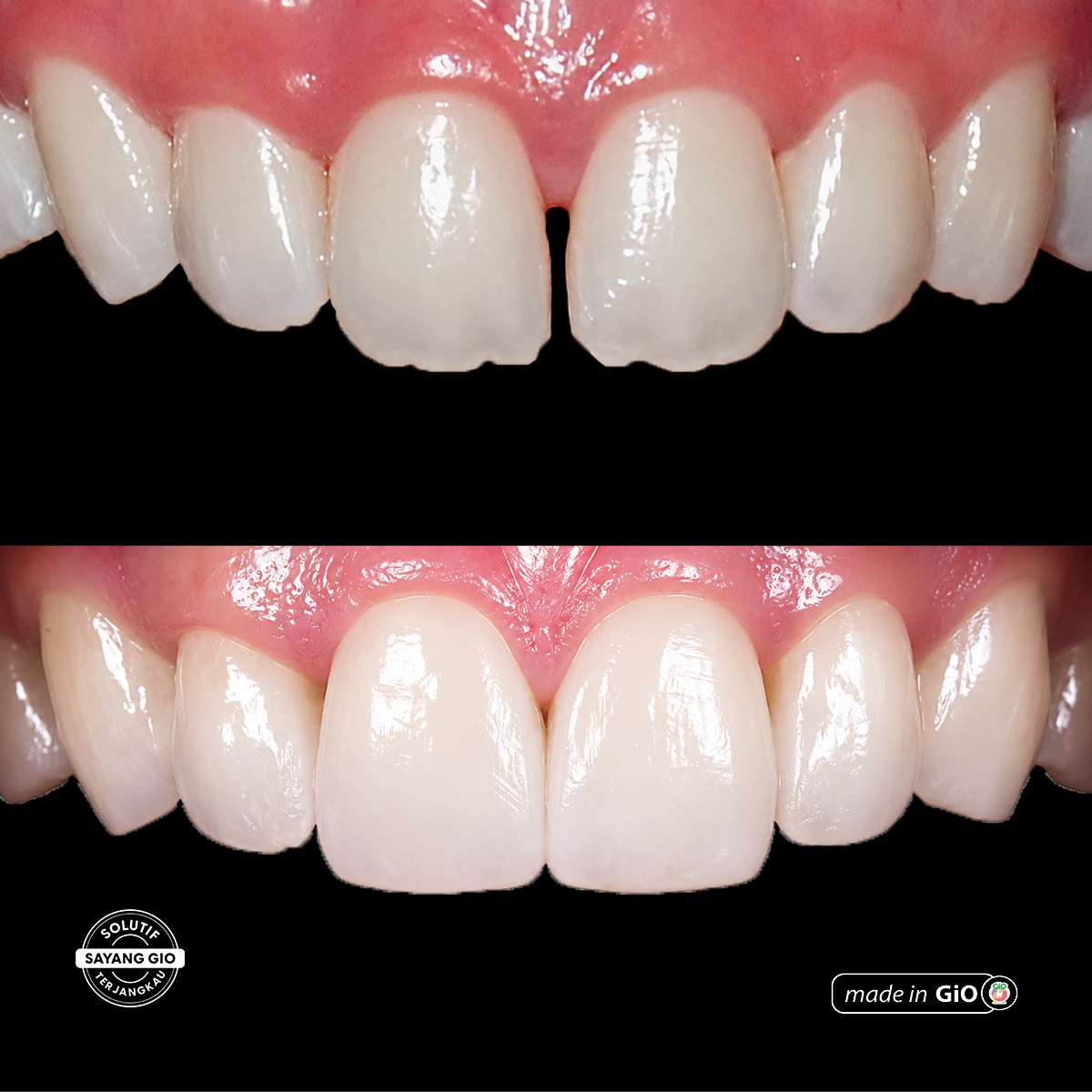 treatment-gio-healthy-veneer