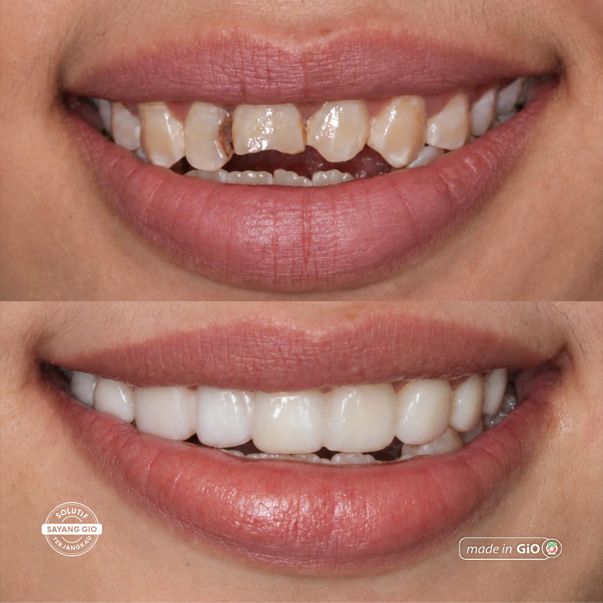 treatment-gio-healthy-veneer