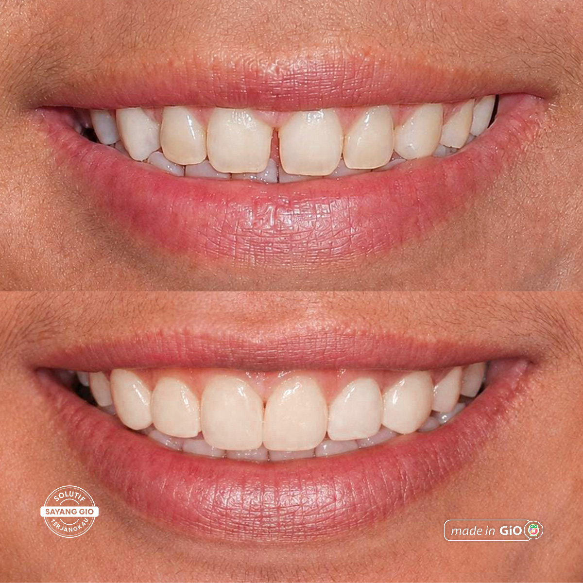 treatment-gio-healthy-veneer