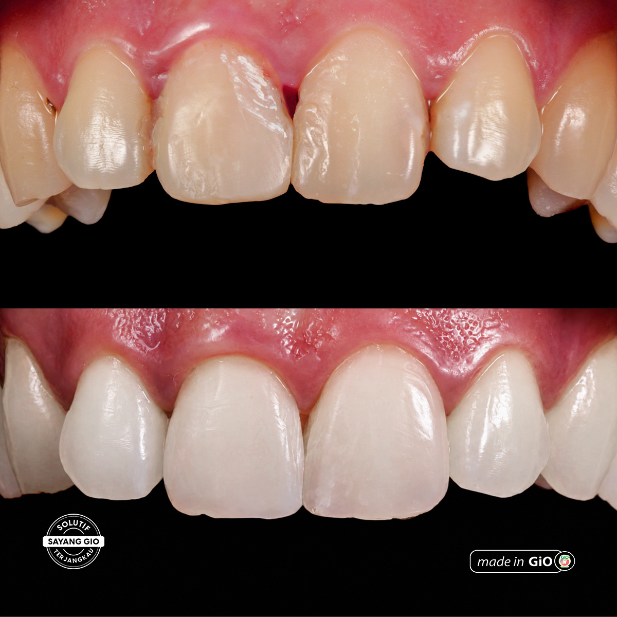 treatment-gio-healthy-veneer